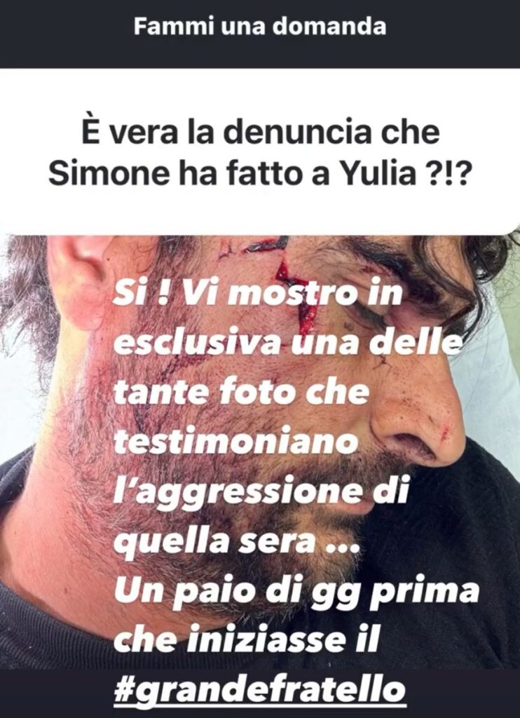 Grande Fratello, Simone mostra le immagini dopo l’aggressione 2